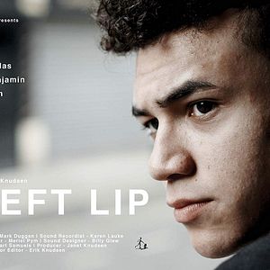 Photo Cleft Lip